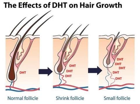 Hair follicles gradually shrink under DHT, a hormone producing thinner hair over time with age.
